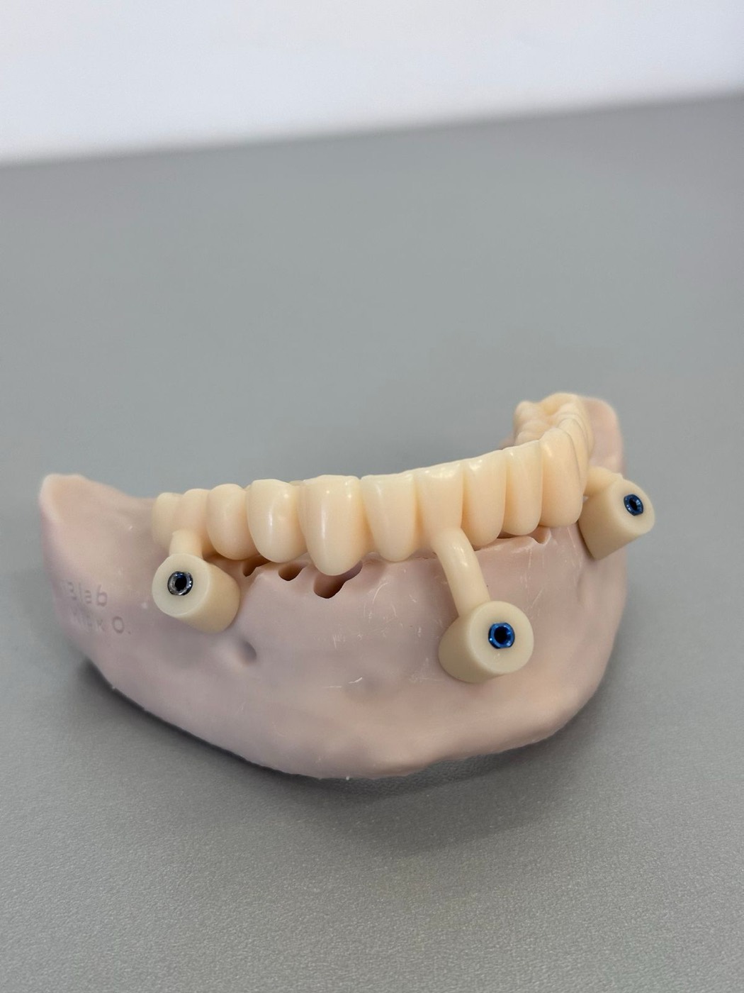 A full-arch implant bridge on a jaw model, supported by four implants
