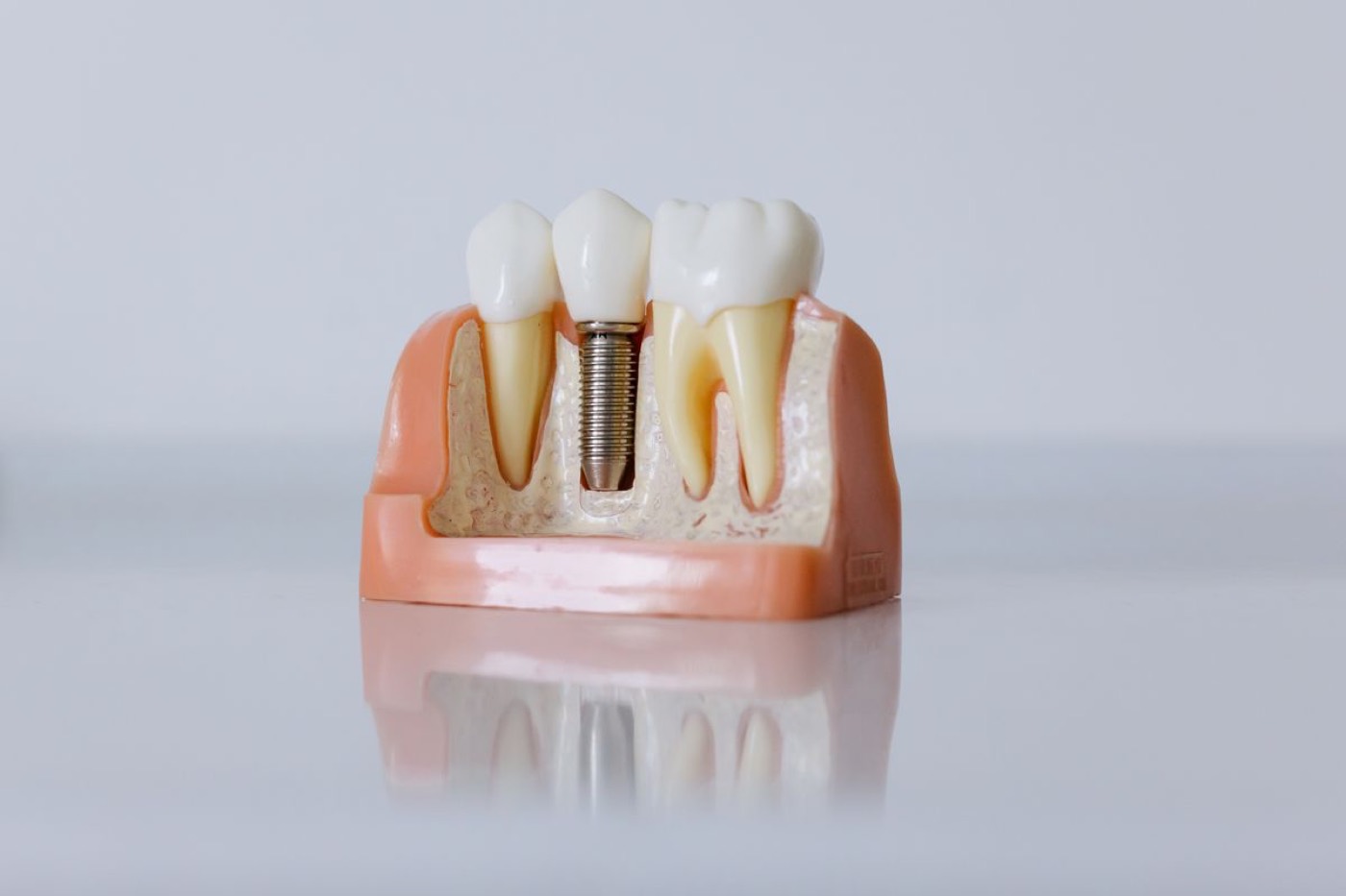 A cutaway model showing a dental implant placed in the jawbone beside natural teeth
