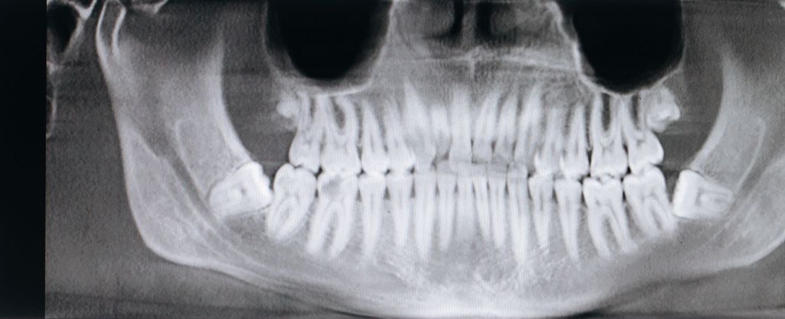 A panoramic dental x-ray showing the position of the wisdom teeth